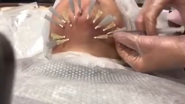 Подтяжка подбородка ThreadLift Iryna Bashura смотреть онлайн