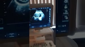 21 нед. Киста сосудистого сплетения