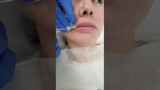 ADVANCE-ТЕРАПИЯ. Омоложение губ препаратом ADVANCE Medium смотреть онлайн