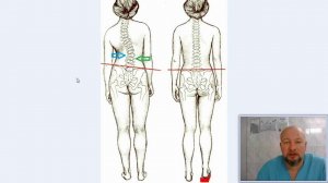 Коксартроз