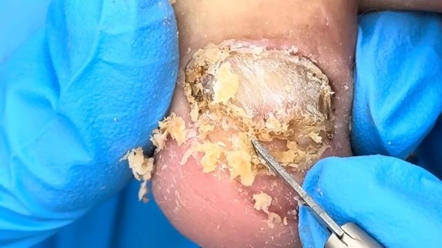 Curly onychomycosis with a thick layer of black mud【Doctor Liu Pedicure】 смотреть онлайн