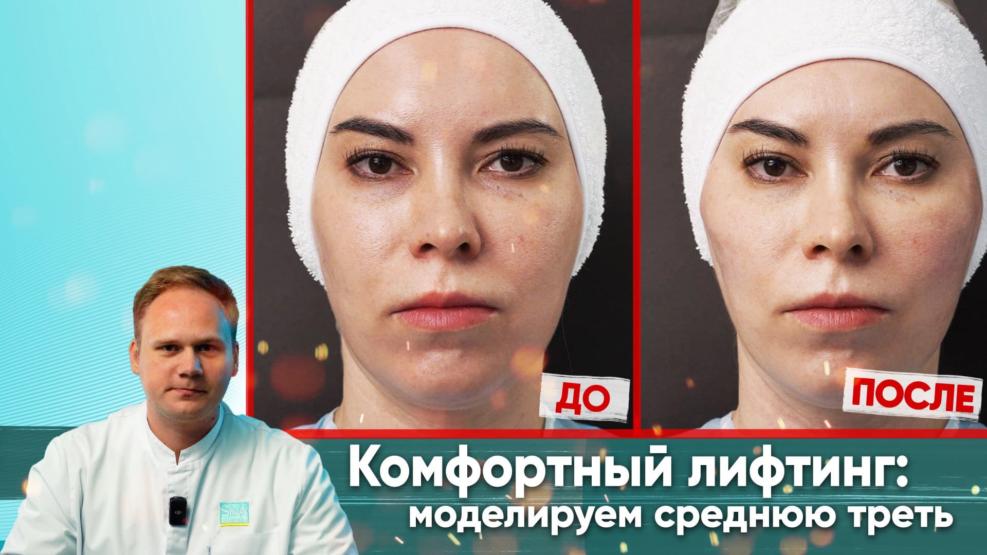 Моделирование средней трети лица