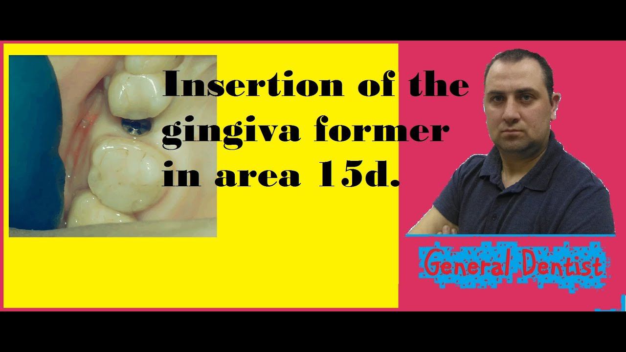 Insertion of the gingiva former in area 15 d.