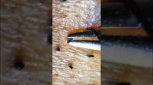 Пинцетом для удаления вросшей бороды for iPhone 2021/2/8