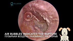 Tympanic membrane rupture/Перфорация барабанной перепонки