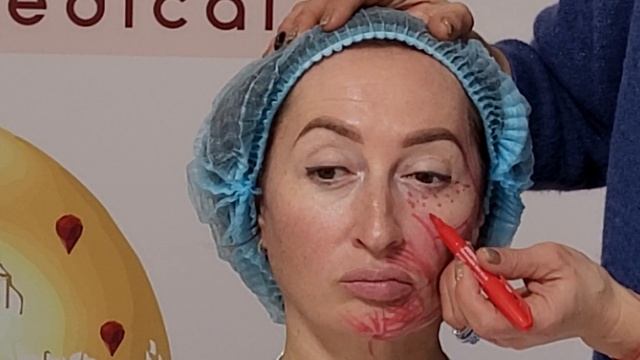 PLLA в периорбитальной области.