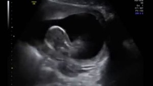 Беременность - 15-16 недель