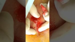pimple popping. выдавливание прыща,угри на лице.