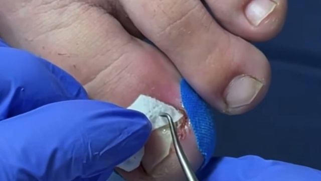 Вросший ноготь????⚠️ смотреть онлайн