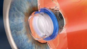 New Implantable Miniature Telescope (IMT) for End-stage Macular Degeneration (AMD)