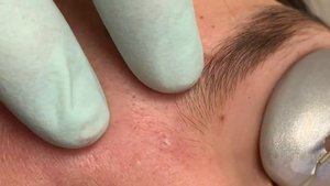 Your new Fave acne Extractions#4. 20 minutes of just the pop. Ear extractions, this one has it all.