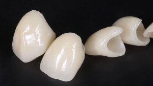 Лучшие зубные коронки | Что выбрать?