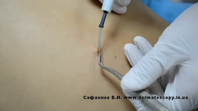 Невус смешанный, удаление методом высокочастотной электрохирургии