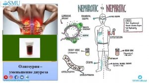 НЕФРИТИЧЕСКИЙ СИНДРОМ У ДЕТЕЕЙ