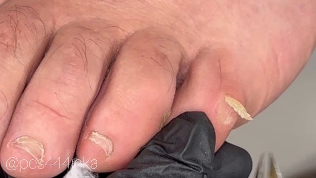 Мозоль на пальце смотреть онлайн