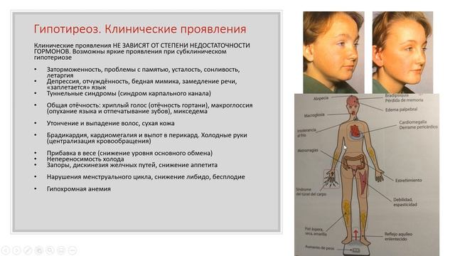 Гипотиреоз 1. Hypothyroidism. Hipotiroidismo
