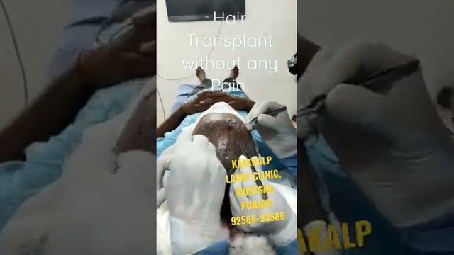 Hair Transplant without any Pain.