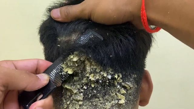 DRY SCALP !! Big Flakes Dandruff Scratching Satisfying Video #768 смотреть онлайн