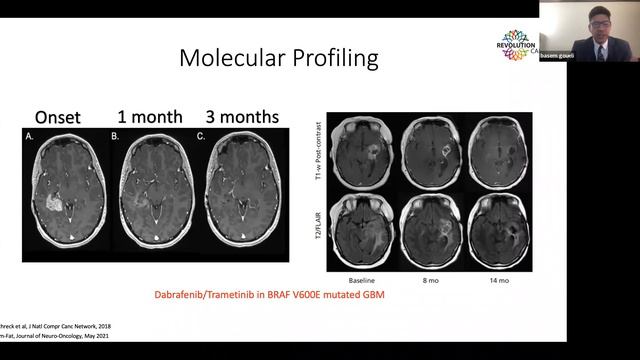The Glioblastoma Brain Cancer Patient Journey DEMYSTIFIED.