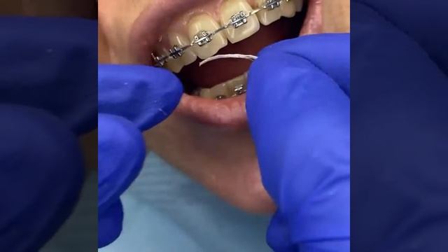 Как пользоваться ёршиками для чистки зубов с брекетами смотреть онлайн