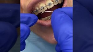 Как пользоваться ёршиками для чистки зубов с брекетами