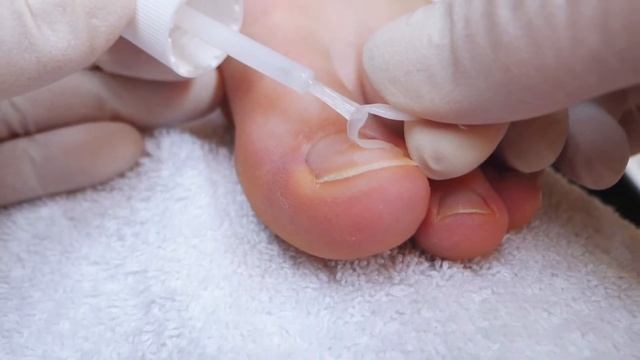 NEW СИСТЕМА КОРРЕКЦИИ ВРОСШЕГО НОГТЯ PODOSTRIPE от компании 3TO смотреть онлайн