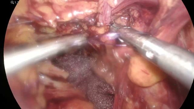 Прямая паховая грыжа справа Direct inguinal hernia right PM2 TAPP