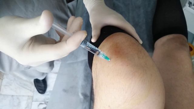 Укол гиалуроновой кислоты в коленный сустав