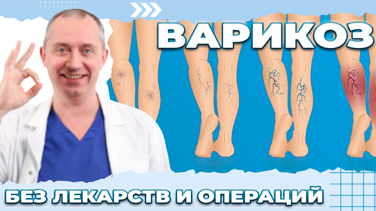 Варикоз! Без лекарств и операций. Лечение варикозной болезни нижних конечностей.