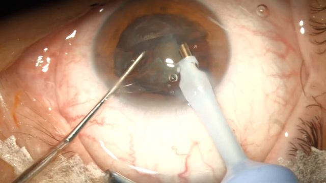 PHACO STUDIES (Stellaris PC): Spin + Wedge chop смотреть онлайн