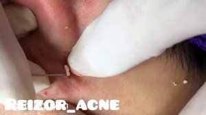 Removes acne, Давим прыщи, чёрные точки. Залипательно 2021