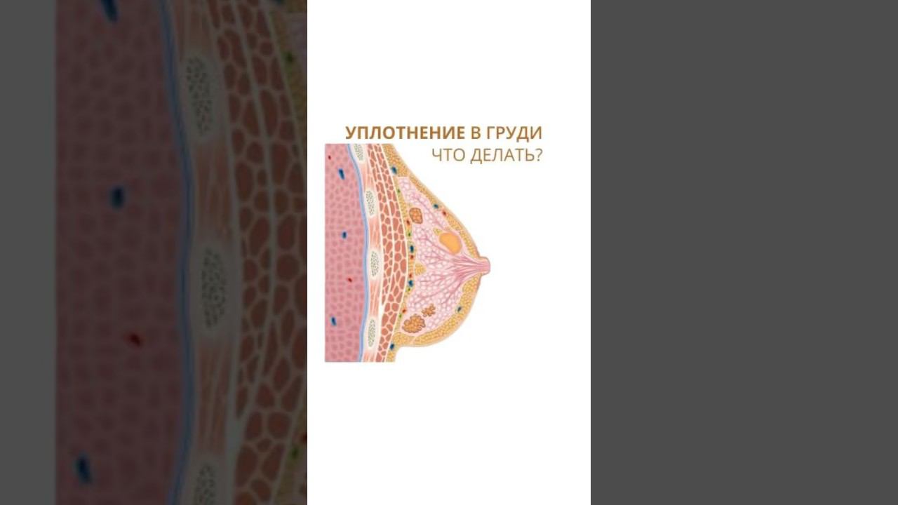 Уплотнение в соске у девочки. Уплотнение в соске у девочки
