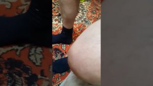 Прокалываем мозоль😰😷