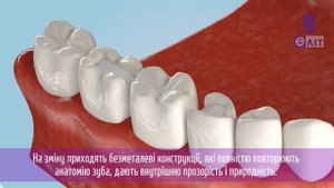 Что такое вкладки на зубы | какие есть виды вкладок на зуб | вкладки коронки