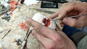 Изготовление бюгельного протеза Постановка искусственных зубов