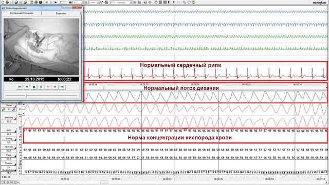Как выглядит сипап-терапия? Терапевтическая ночь с сипап-аппаратом.