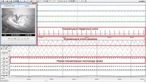 Как выглядит сипап-терапия? Терапевтическая ночь с сипап-аппаратом.