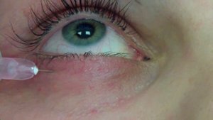 БИОРЕВИТАЛИЗАЦИЯ ПЕРИОРБИТАЛЬНОЙ ОБЛАСТИ С ИСПОЛЬЗОВАНИЕМ ПРЕПАРАТА Overage MESO (Италия)