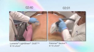 The Palomar Vectus Laser vs  the Lumenis LightSheer Duet