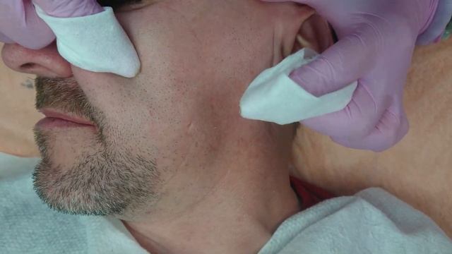 Комбинированная чистка лица/Чистка ультразвуком/Механическая чистка/Химический пилинг