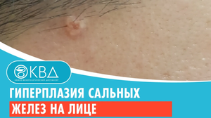 ?? Гиперплазия сальных желез на лице. Клинический случай №1003
