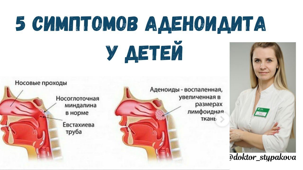 Аденоидит у детей.Как на раннем этапе заметить увеличение аденоидов у ребёнка?5 симптомов аденоидита смотреть онлайн