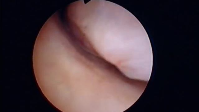 Полип цервикального канала смотреть онлайн