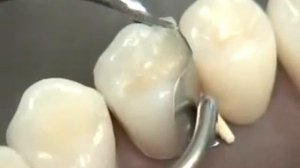 Препарирование по Блэку 2 класс