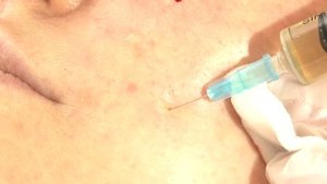 Как использовать Мэлсмон? Мастер-класс по технике введения плацентарного препарата МЭЛСМОН