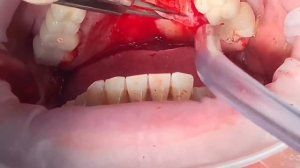 Пересадка свободного десневого трансплантанта с неба в область имплантов и пересаженной кости.