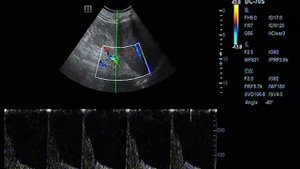 Стеноз правой почечной артерии