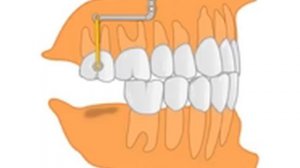 Интрузия одиночного моляра якорной пластиной PM 01 05 или PM 01 06