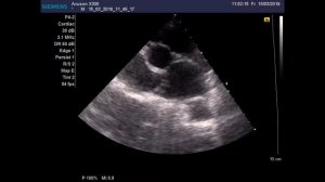 Аневризма МПП