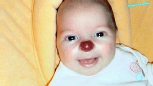 Над НЕЙ все смеялись..  Как сейчас выглядит девочка, которая родилась с «клоунским» носиком..